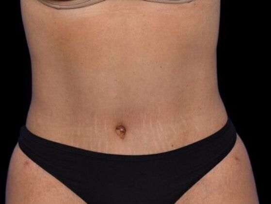 Tummy Tuck with Contouring Case 2 - After