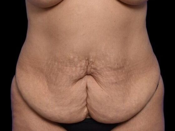 Tummy Tuck with Contouring Case 2 - Before
