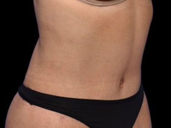 Tummy Tuck with Contouring: Case 2 - After
