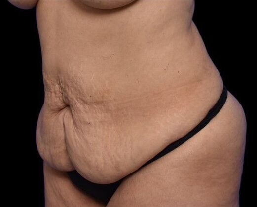 Tummy Tuck with Contouring: Case 2 - Before