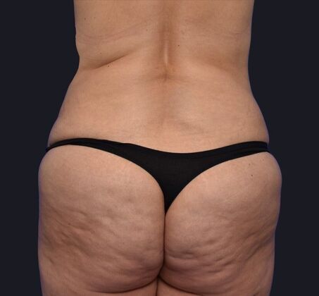 Tummy Tuck with Contouring: Case 2 - Before