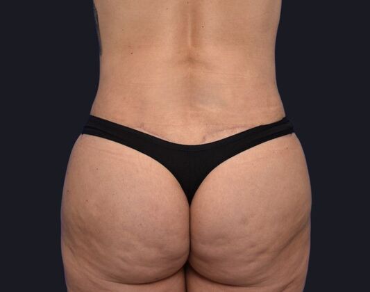 Tummy Tuck with Contouring: Case 2 - After