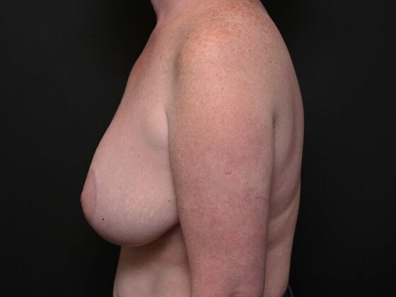 Breast Lift: Case 2 - Before