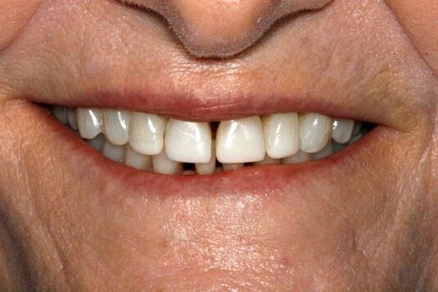 Cosmetic Dentistry Upper and Lower Veneers - Before