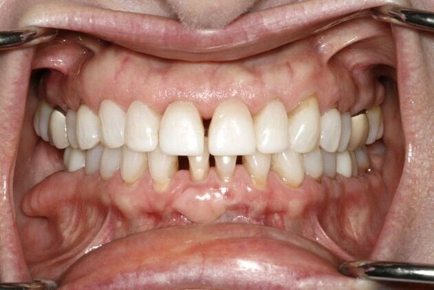 Cosmetic Dentistry: Upper and Lower Veneers - Before