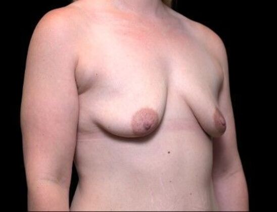 Breast Lift: Case 3 - After