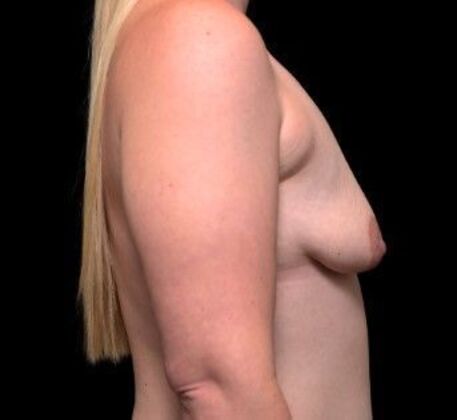 Breast Lift: Case 3 - After