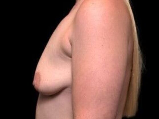 Breast Lift: Case 3 - Before