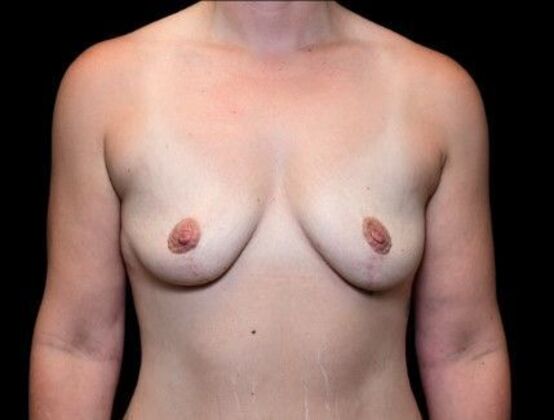 Breast Lift Case 3 - After
