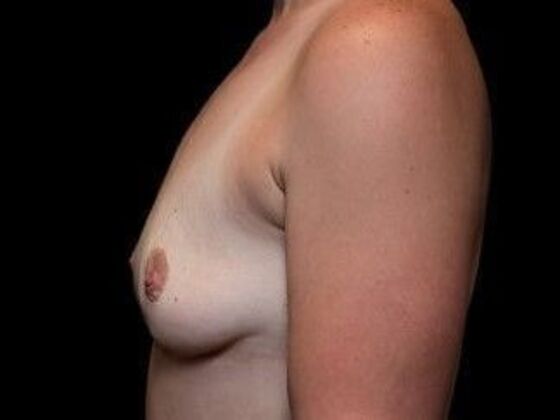 Breast Lift: Case 3 - After