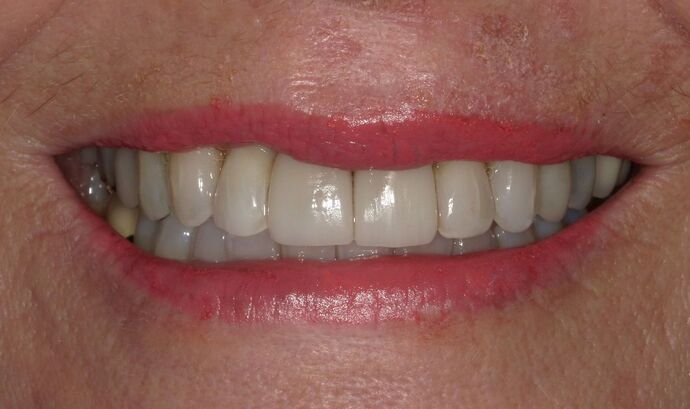 Invisalign: Case 12 - After