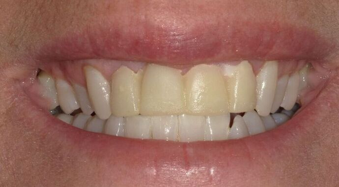 Dental Implants Case 15 - Before