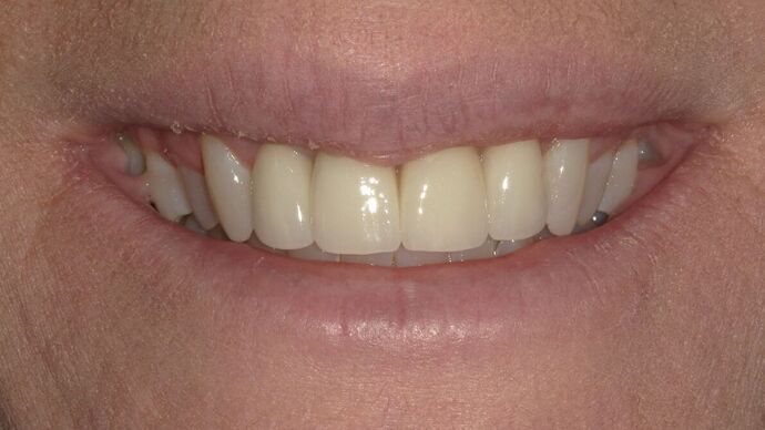 Dental Implants Case 15 - After