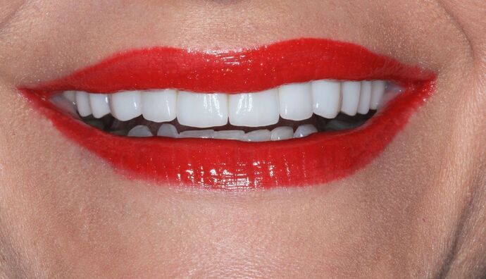 Porcelain Veneers Case 26 - After