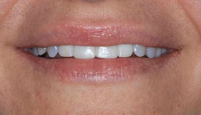 Porcelain Veneers Case 26 - Before