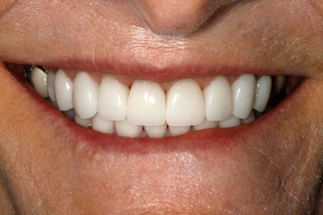 Cosmetic Dentistry Upper and Lower Veneers - After