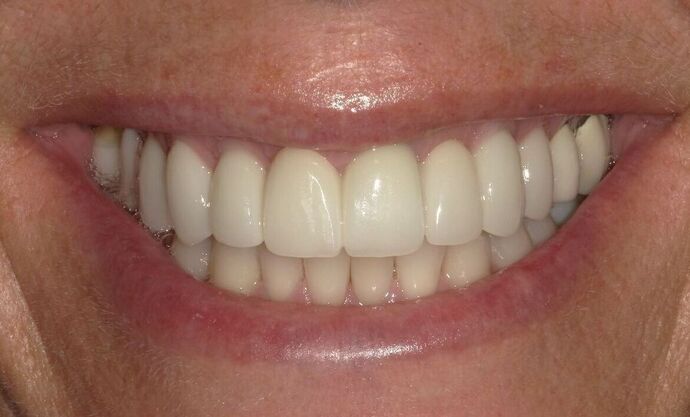 Dental Implants Case 11 - After