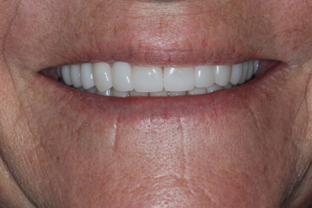Full Mouth Reconstruction: Case 32 - After