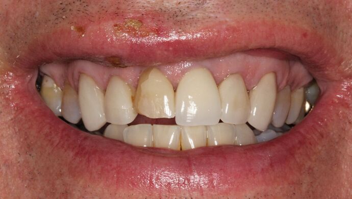 Full Mouth Reconstruction: Case 33 - After