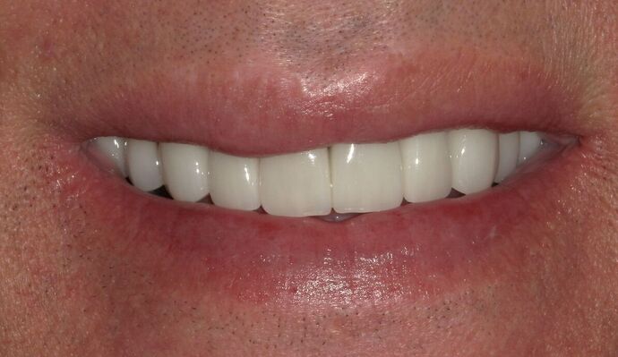 Full Mouth Reconstruction: Case 33 - Before
