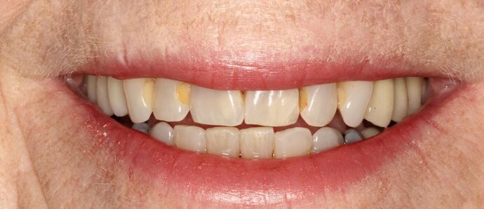 Full Mouth Reconstruction: Case 5 - Before