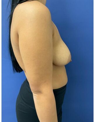 Breast Reduction/ Breast Lift: Case 18 - Before