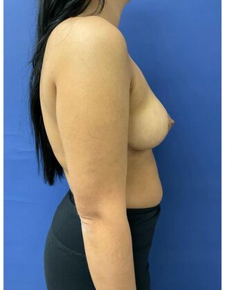 Breast Reduction/ Breast Lift: Case 18 - After