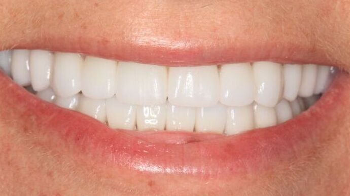 Dental Implants Case 1 - After