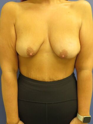 Breast Reduction/ Breast Lift Case 19 - Before