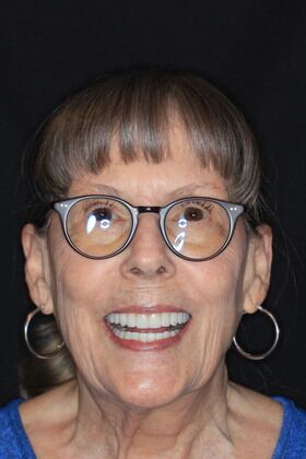 Full Mouth Reconstruction Cases