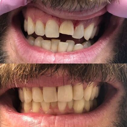 Click Here to See More Before & After Photos Anterior Crown