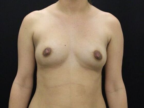 Breast Augmentation: Case 116 - Before