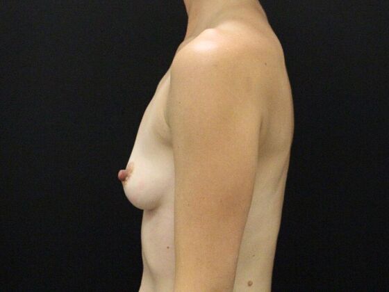 Breast Augmentation: Case 117 - Before