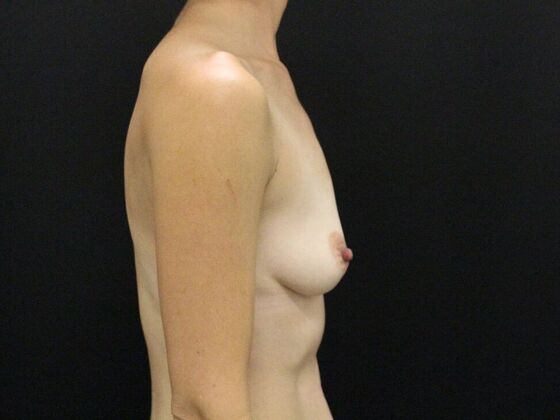 Breast Augmentation: Case 117 - Before