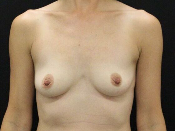 Breast Augmentation: Case 117 - Before