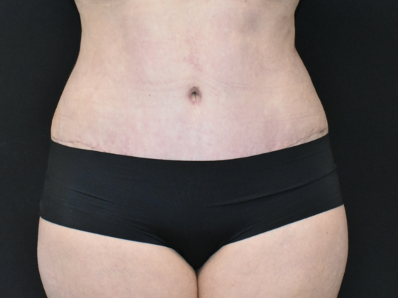 Abdominoplasty: Case 19 - Before