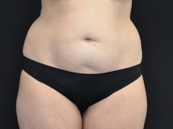 Abdominoplasty: Case 19 - After