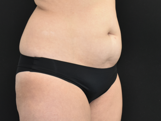 Abdominoplasty: Case 19 - Before