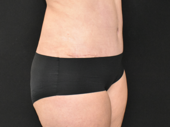 Abdominoplasty: Case 19 - After