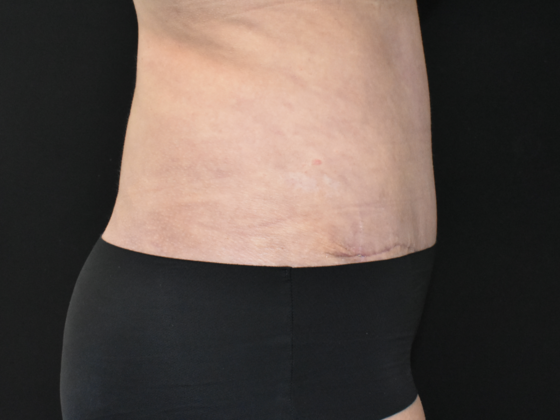 Abdominoplasty: Case 19 - Before