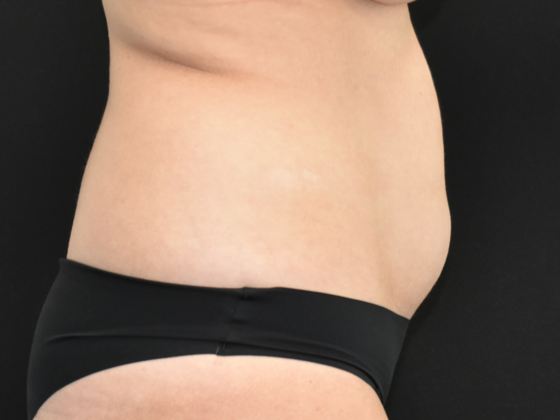 Abdominoplasty: Case 19 - After
