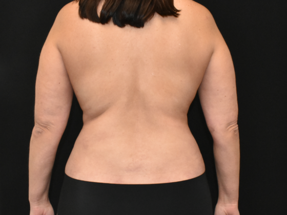 Abdominoplasty: Case 19 - After