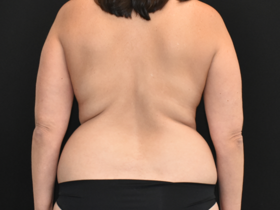Abdominoplasty: Case 19 - Before