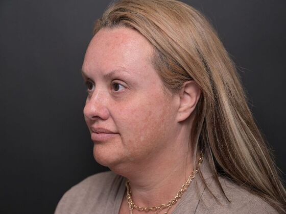 Facial Rejuvenation Case 1 - Before