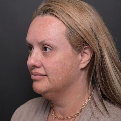 Facial Rejuvenation Case 1 - Before