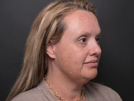 Facial Rejuvenation: Case 1 - Before