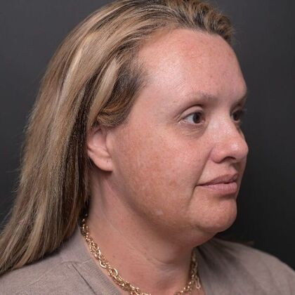 Facial Rejuvenation: Case 1 - Before