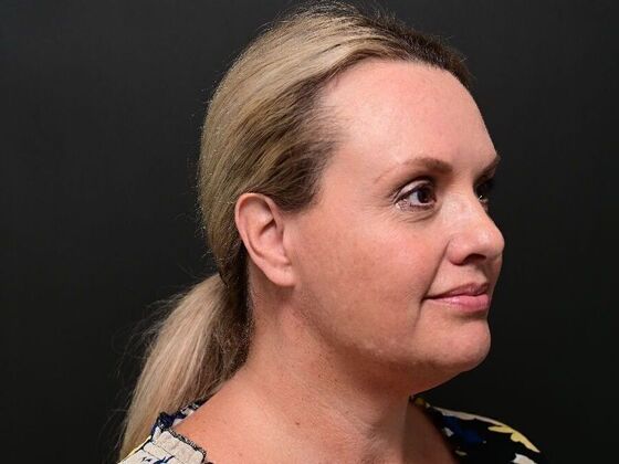 Facial Rejuvenation: Case 1 - After