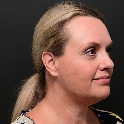 Facial Rejuvenation: Case 1 - After