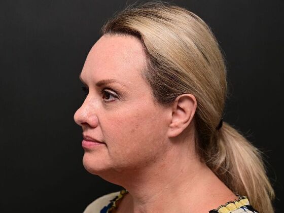 Facial Rejuvenation Case 1 - After